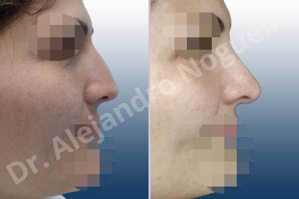 Alar rim retraction,Andine nose,Arabic nose,Asian nose,Asymmetric nose,Asymmetric tip,Bifid tip,Concave lateral cruras,Congenital nose,Crooked nose,Dorsum hump,Dorsum ridges,Hispanic nose,Humpless dorsum,Jewish nose,Low radix,Mixed race blood,Narrow dorsum,Narrow nose,Overrotated tip,Pinched middle vault,Pinched nose,Pointy tip,Poorly supported tip,Rhomboid dorsum,Short nose,Short septum,Short upper lateral cartilages,Small alar cartilages,Small nose,Sunken columella,Sunken supratip,Tension nose,Thin skin nose,Underprojected tip,Columella lengthening,Custom made tip graft,Dorsum hump resection,Dorsum plateau resection,Ear cartilage graft harvesting,Extended shield tip columella graft,Intercrural columella plasty sutures,Interdomal tip plasty sutures,Lateral cruras batten graft,Lateral cruras caudal extension graft,Lateral cruras custom made graft,Lateral cruras lengthening graft,Lateral cruras replacement graft,Lateral cruras repositioning,Medial cruras custom made graft,Nasal bones osteotomies,Onlay columella graft,Onlay supratip graft,Onlay tip graft,Open approach incision,Shield tip graft,Spreader graft,Temporalis fascia graft harvesting,Tip replacement graft,Triangular cartilages caudal extension graft - photo 5