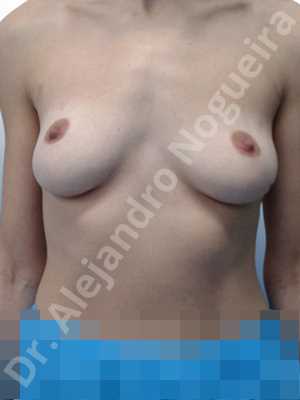 Cross eyed breasts,Empty breasts,Lateral breasts,Mildly saggy droopy breasts,Pendulous breasts,Small breasts,Sunken chest,Too far apart wide cleavage breasts,Wide breasts,Anatomical shape,Lower hemi periareolar incision,Subfascial pocket plane
