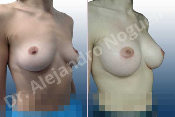 Cross eyed breasts,Empty breasts,Lateral breasts,Mildly saggy droopy breasts,Pendulous breasts,Small breasts,Sunken chest,Too far apart wide cleavage breasts,Wide breasts,Anatomical shape,Lower hemi periareolar incision,Subfascial pocket plane - photo 5