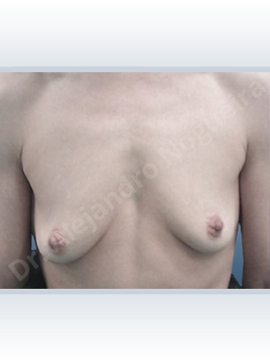 Asymmetric breasts,Empty breasts,Lateral breasts,Mildly saggy droopy breasts,Pigeon chest,Skinny breasts,Slightly saggy droopy breasts,Small breasts,Sunken chest,Too far apart wide cleavage breasts,Wide breasts,Anatomical shape,Extra large size,Lower hemi periareolar incision,Subfascial pocket plane