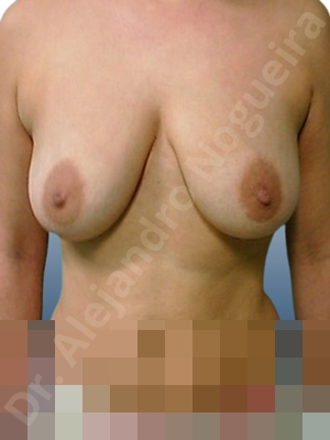 Empty breasts,Large areolas,Mildly large breasts,Moderately large breasts,Moderately saggy droopy breasts,Pendulous breasts,Pigeon chest,Severely saggy droopy breasts,Wide breasts,Anatomical shape,Anchor incision,Areola reduction,Double vertical pedicle,Subfascial pocket plane