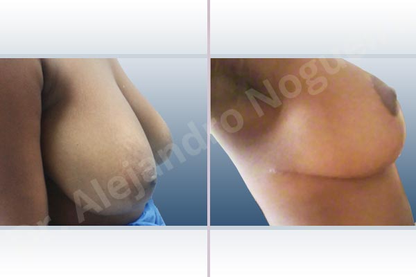 Breast tissues symmastia uniboob,Large areolas,Lateral breasts,Pendulous breasts,Severely large breasts,Tuberous breasts,Anchor incision,Areola reduction,Double vertical pedicle - photo 2