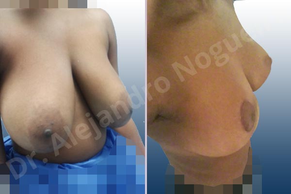 Breast tissues symmastia uniboob,Large areolas,Lateral breasts,Pendulous breasts,Severely large breasts,Tuberous breasts,Anchor incision,Areola reduction,Double vertical pedicle - photo 3