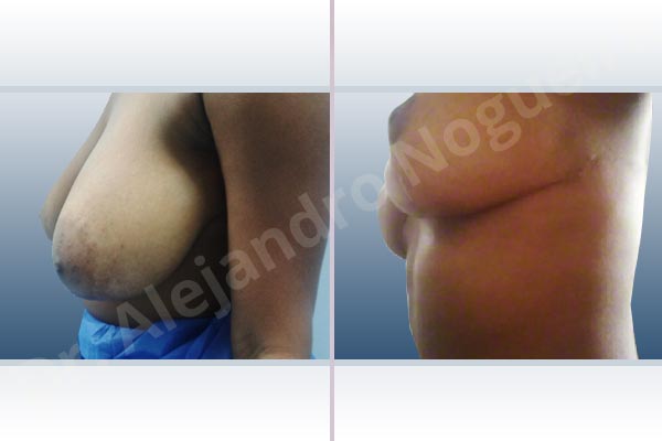 Breast tissues symmastia uniboob,Large areolas,Lateral breasts,Pendulous breasts,Severely large breasts,Tuberous breasts,Anchor incision,Areola reduction,Double vertical pedicle - photo 4