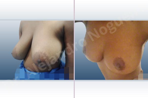 Breast tissues symmastia uniboob,Large areolas,Lateral breasts,Pendulous breasts,Severely large breasts,Tuberous breasts,Anchor incision,Areola reduction,Double vertical pedicle - photo 5