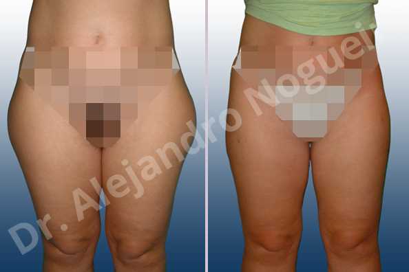Banana rolls flab,Fatty inner knee,Saddle bags flab,Thigh gap flab,Tumescent liposuction - photo 1