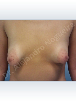 Empty breasts,Large areolas,Lateral breasts,Mildly saggy droopy breasts,Moderately saggy droopy breasts,Narrow breasts,Skinny breasts,Small breasts,Too far apart wide cleavage breasts,Tuberous breasts,Wide breasts,Anatomical shape,Areola reduction,Circumareolar incision,Subfascial pocket plane,Tuberous mammoplasty