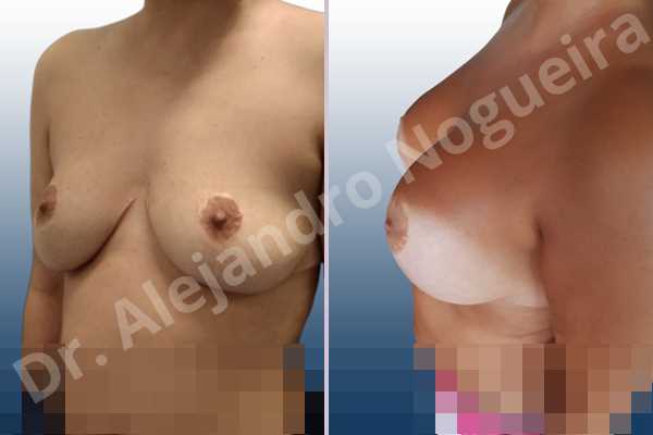 Asymmetric breasts,Breast tissue bottoming out,Cross eyed breasts,Empty breasts,Failed breast reduction,Pendulous breasts,Pigeon chest,Slightly saggy droopy breasts,Small breasts,Wide breasts,Anatomical shape,Anchor incision,Custom incision,Extra large size,Subfascial pocket plane - photo 3