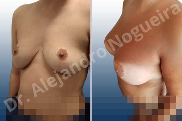 Asymmetric breasts,Breast tissue bottoming out,Cross eyed breasts,Empty breasts,Failed breast reduction,Pendulous breasts,Pigeon chest,Slightly saggy droopy breasts,Small breasts,Wide breasts,Anatomical shape,Anchor incision,Custom incision,Extra large size,Subfascial pocket plane - photo 4