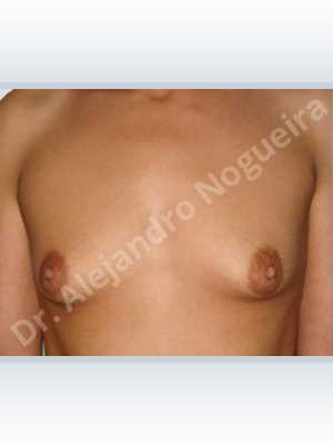 Lateral breasts,Skinny breasts,Small breasts,Too far apart wide cleavage breasts,Tuberous breasts,Extra large size,Lower hemi periareolar incision,Round shape,Subfascial pocket plane,Tuberous mammoplasty