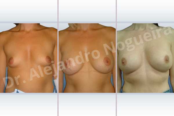 Empty breasts,Lateral breasts,Small breasts,Too far apart wide cleavage breasts,Dual plane pocket,Lower hemi periareolar incision,Round shape - photo 1
