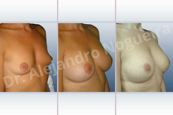 Empty breasts,Lateral breasts,Small breasts,Too far apart wide cleavage breasts,Dual plane pocket,Lower hemi periareolar incision,Round shape - photo 5