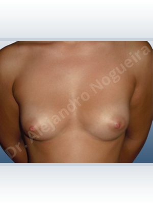 Cross eyed breasts,Narrow breasts,Small breasts,Anatomical shape,Lower hemi periareolar incision,Subfascial pocket plane