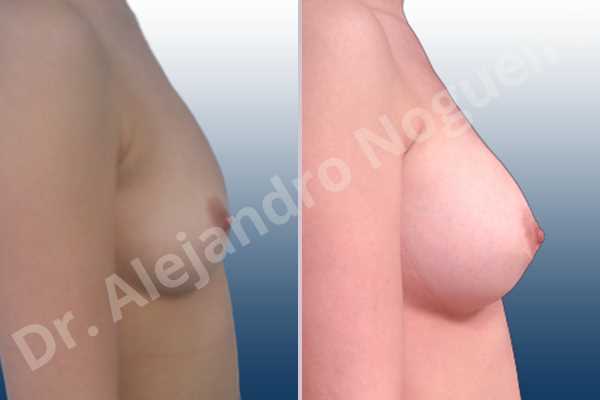 Asymmetric breasts,Empty breasts,Lateral breasts,Pigeon chest,Small breasts,Too far apart wide cleavage breasts,Lower hemi periareolar incision,Round shape,Subfascial pocket plane - photo 4