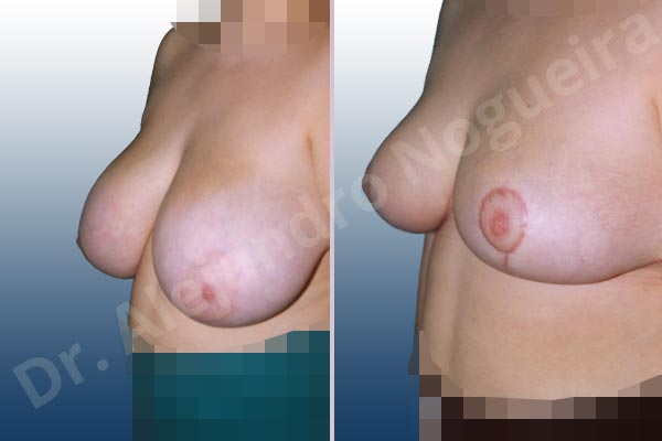 Extremely saggy droopy breasts,Severely large breasts,Tuberous breasts,Anchor incision,Double vertical pedicle - photo 2