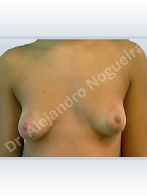 Asymmetric breasts,Empty breasts,Large areolas,Narrow breasts,Skinny breasts,Slightly saggy droopy breasts,Small breasts,Sunken chest,Too far apart wide cleavage breasts,Tuberous breasts,Anatomical shape,Lower hemi periareolar incision,Subfascial pocket plane,Tuberous mammoplasty