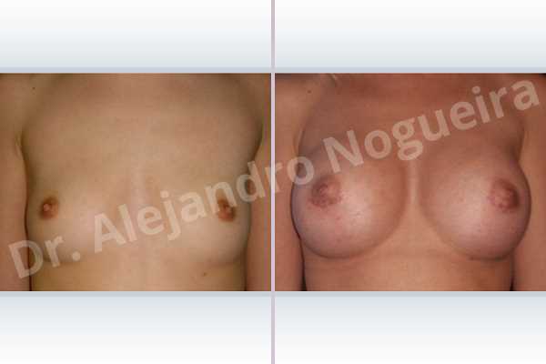 Lateral breasts,Pigeon chest,Skinny breasts,Small breasts,Too far apart wide cleavage breasts,Lower hemi periareolar incision,Round shape,Subfascial pocket plane - photo 1