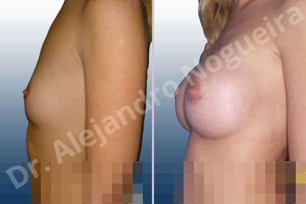 Lateral breasts,Pigeon chest,Skinny breasts,Small breasts,Too far apart wide cleavage breasts,Lower hemi periareolar incision,Round shape,Subfascial pocket plane - photo 2