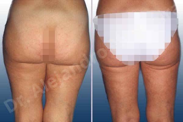 Before & After Case YLRTJEKM