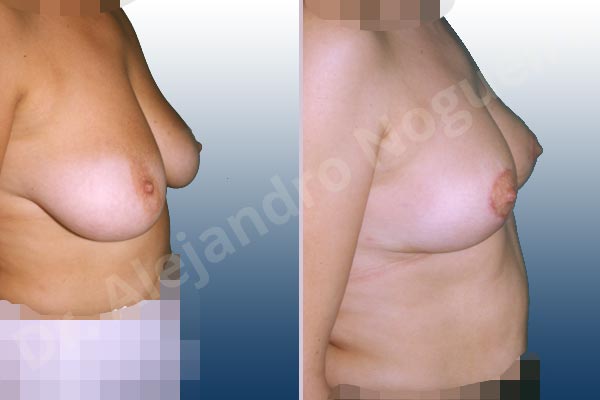 Breast tissue bottoming out,Moderately saggy droopy breasts,Pendulous breasts,Lollipop incision,Superior pedicle - photo 1