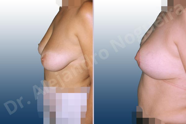 Breast tissue bottoming out,Moderately saggy droopy breasts,Pendulous breasts,Lollipop incision,Superior pedicle - photo 2