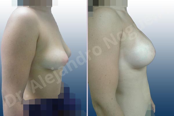 Asymmetric breasts,Empty breasts,Large areolas,Mildly saggy droopy breasts,Narrow breasts,Slightly saggy droopy breasts,Small breasts,Too far apart wide cleavage breasts,Tuberous breasts,Anatomical shape,Areola reduction,Circumareolar incision,Subfascial pocket plane,Tuberous mammoplasty - photo 2