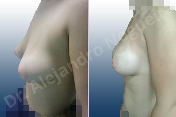 Asymmetric breasts,Empty breasts,Large areolas,Mildly saggy droopy breasts,Narrow breasts,Slightly saggy droopy breasts,Small breasts,Too far apart wide cleavage breasts,Tuberous breasts,Anatomical shape,Areola reduction,Circumareolar incision,Subfascial pocket plane,Tuberous mammoplasty - photo 4