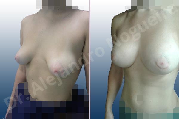 Asymmetric breasts,Empty breasts,Large areolas,Mildly saggy droopy breasts,Narrow breasts,Slightly saggy droopy breasts,Small breasts,Too far apart wide cleavage breasts,Tuberous breasts,Anatomical shape,Areola reduction,Circumareolar incision,Subfascial pocket plane,Tuberous mammoplasty - photo 5