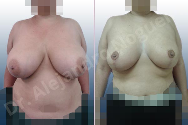 Extremely large breasts,Large areolas,Lateral breasts,Moderately saggy droopy breasts,Areola reduction,Lollipop incision,Superior pedicle - photo 1