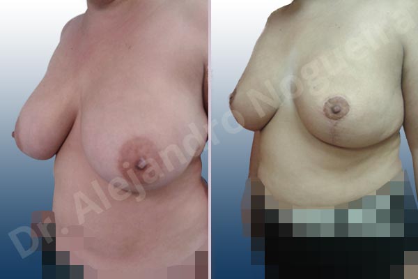 Extremely large breasts,Large areolas,Lateral breasts,Moderately saggy droopy breasts,Areola reduction,Lollipop incision,Superior pedicle - photo 3