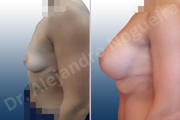 Asymmetric breasts,Empty breasts,Skinny breasts,Slightly saggy droopy breasts,Small breasts,Anatomical shape,Extra large size,Lower hemi periareolar incision,Subfascial pocket plane - photo 2
