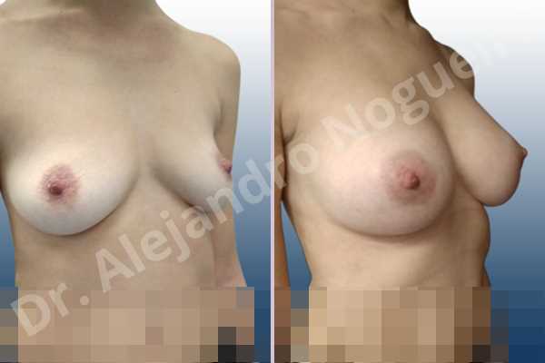 Asymmetric breasts,Cross eyed breasts,Empty breasts,Lateral breasts,Moderately saggy droopy breasts,Pendulous breasts,Pigeon chest,Small breasts,Too far apart wide cleavage breasts,Anatomical shape,Lower hemi periareolar incision,Subfascial pocket plane - photo 5