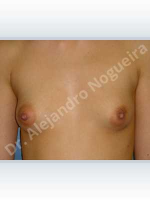 Asymmetric breasts,Large areolas,Lateral breasts,Narrow breasts,Skinny breasts,Small breasts,Too far apart wide cleavage breasts,Tuberous breasts,Anatomical shape,Areola reduction,Circumareolar incision,Subfascial pocket plane,Tuberous mammoplasty