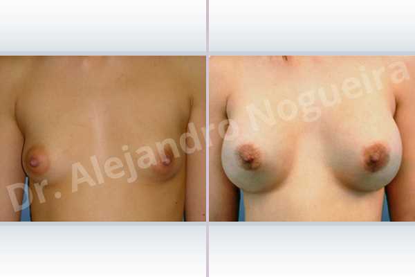 Asymmetric breasts,Large areolas,Lateral breasts,Narrow breasts,Skinny breasts,Small breasts,Too far apart wide cleavage breasts,Tuberous breasts,Anatomical shape,Areola reduction,Circumareolar incision,Subfascial pocket plane,Tuberous mammoplasty - photo 1