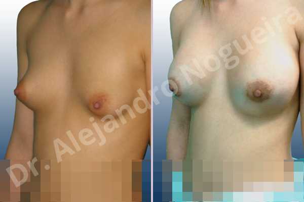 Asymmetric breasts,Large areolas,Lateral breasts,Narrow breasts,Skinny breasts,Small breasts,Too far apart wide cleavage breasts,Tuberous breasts,Anatomical shape,Areola reduction,Circumareolar incision,Subfascial pocket plane,Tuberous mammoplasty - photo 3