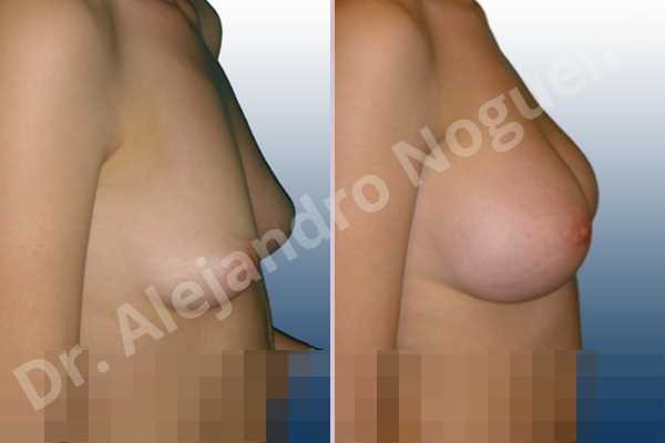 Asymmetric breasts,Cross eyed breasts,Empty breasts,Lateral breasts,Narrow breasts,Pigeon chest,Skinny breasts,Small breasts,Too far apart wide cleavage breasts,Tuberous breasts,Anatomical shape,Subfascial pocket plane,Transareolar incision,Tuberous mammoplasty - photo 4