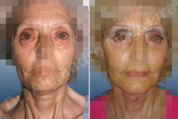 Baggy lower eyelids,Deep nasolabial folds,Double chin flab,Droopy cheeks,Droopy face,Saggy jowls,Saggy neck,Deep plane SMAS platysma face and neck lift,Lower eyelid fat bags resection,Transconjunctival approach incision - photo 1