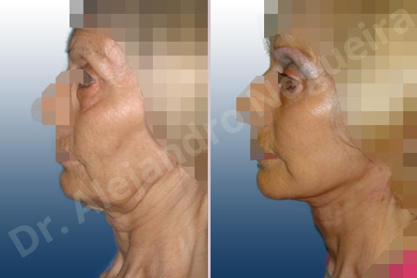 Baggy lower eyelids,Deep nasolabial folds,Double chin flab,Droopy cheeks,Droopy face,Saggy jowls,Saggy neck,Deep plane SMAS platysma face and neck lift,Lower eyelid fat bags resection,Transconjunctival approach incision - photo 2