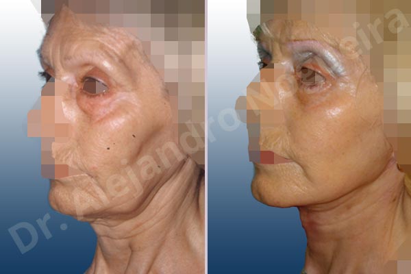 Baggy lower eyelids,Deep nasolabial folds,Double chin flab,Droopy cheeks,Droopy face,Saggy jowls,Saggy neck,Deep plane SMAS platysma face and neck lift,Lower eyelid fat bags resection,Transconjunctival approach incision - photo 3