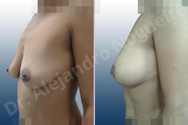 Cleft nipples,Empty breasts,Inverted nipples,Moderately saggy droopy breasts,Small breasts,Anatomical shape,Lower hemi periareolar incision,Subfascial pocket plane - photo 2