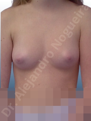 Asymmetric breasts,Narrow breasts,Small breasts,Tuberous breasts,Anatomical shape,Lower hemi periareolar incision,Subfascial pocket plane,Tuberous mammoplasty