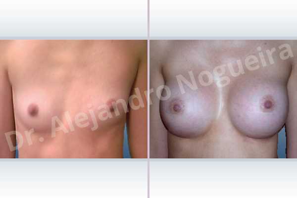 Asymmetric breasts,Skinny breasts,Small breasts,Inframammary incision,Round shape,Subfascial pocket plane - photo 1