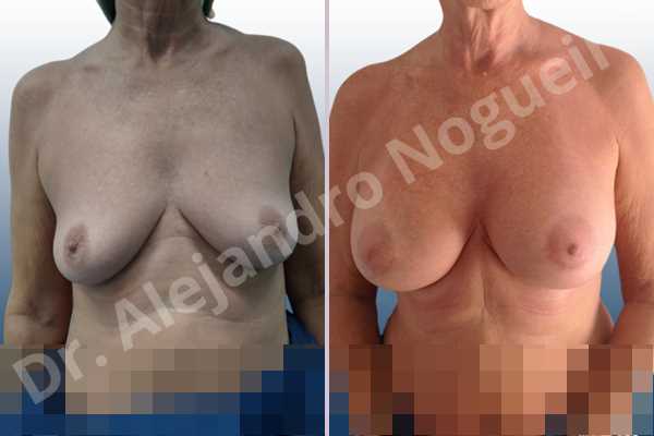 Before & After Case ZHF6EUB2