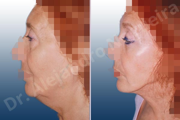 Baggy lower eyelids,Baggy upper eyelids,Deep nasolabial folds,Double chin flab,Droopy cheeks,Droopy face,Saggy jowls,Saggy neck,Saggy upper eyelids,Deep plane SMAS platysma face and neck lift,Lower eyelid fat bags resection,Transconjunctival approach incision,Upper eyelid fat bags resection,Upper eyelid skin and muscle resection - photo 2