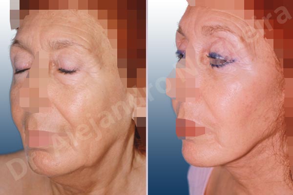Baggy lower eyelids,Baggy upper eyelids,Deep nasolabial folds,Double chin flab,Droopy cheeks,Droopy face,Saggy jowls,Saggy neck,Saggy upper eyelids,Deep plane SMAS platysma face and neck lift,Lower eyelid fat bags resection,Transconjunctival approach incision,Upper eyelid fat bags resection,Upper eyelid skin and muscle resection - photo 3