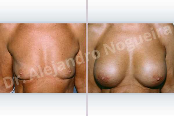 Empty breasts,Lateral breasts,Pigeon chest,Skinny breasts,Slightly saggy droopy breasts,Small breasts,Too far apart wide cleavage breasts,Wide breasts,Anatomical shape,Lower hemi periareolar incision,Subfascial pocket plane - photo 1