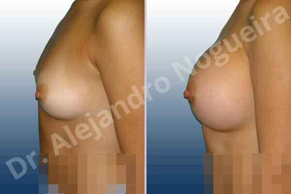 Asymmetric breasts,Cross eyed breasts,Lateral breasts,Pigeon chest,Slightly saggy droopy breasts,Small breasts,Too far apart wide cleavage breasts,Lower hemi periareolar incision,Round shape,Subfascial pocket plane - photo 2
