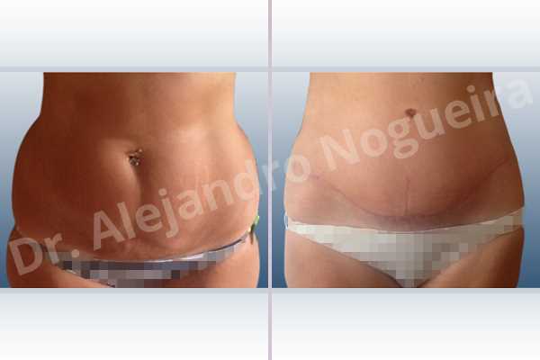 Saggy abdomen,Weak abdomen muscles,Standard abdominoplasty