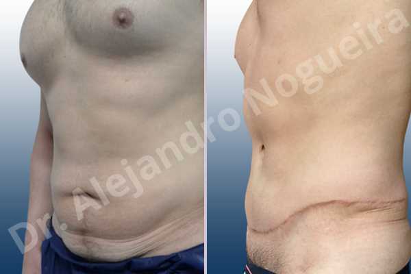 Saggy abdomen,Standard abdominoplasty - photo 3