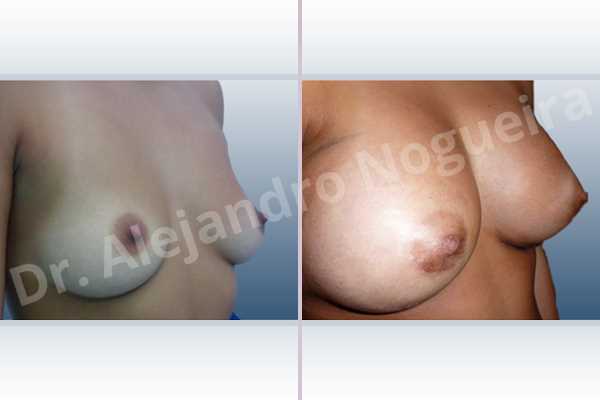 Empty breasts,Lateral breasts,Pigeon chest,Slightly saggy droopy breasts,Small breasts,Too far apart wide cleavage breasts,Wide breasts,Anatomical shape,Extra large size,Lower hemi periareolar incision,Subfascial pocket plane - photo 4